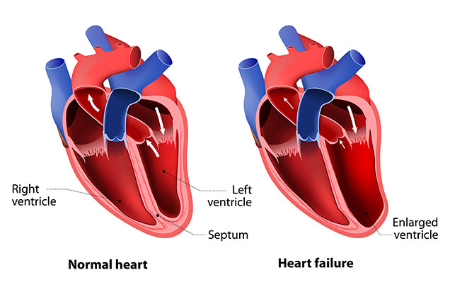 Congestive Heart Failure (CHF)