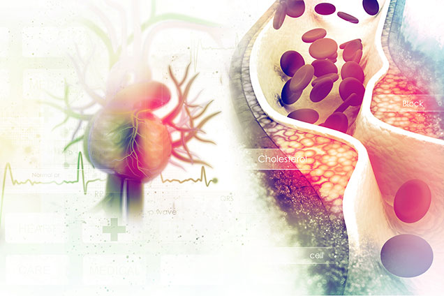 Coronary Artery Disease