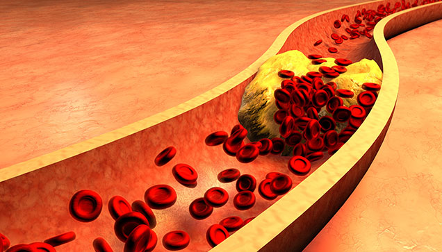 Hypercholesterolemia