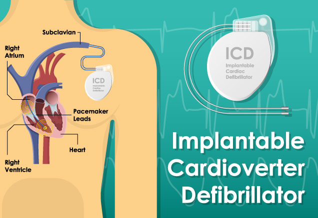 Implantable Cardioverter Defibrillator (ICD) Placement