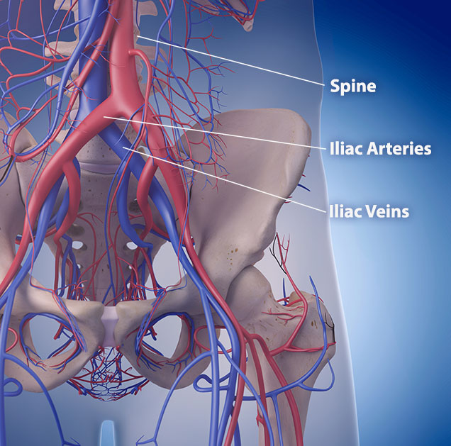 Iliocaval IVUS and Stenting