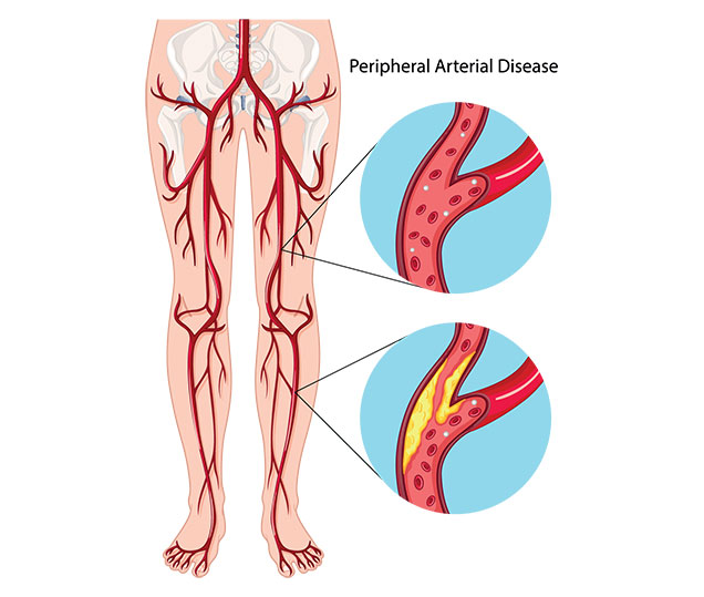 Lower Extremity Arterial Ultrasound