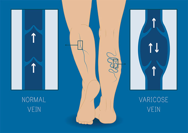 Lower Extremity Venous with Reflux Ultrasound