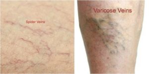 varicose_vs_spider_veins