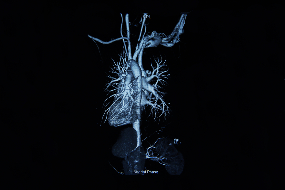 Angiograms 3D Photo