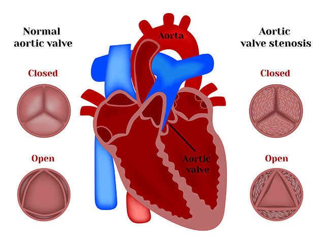 Aortic Stenosis Flow Diagram