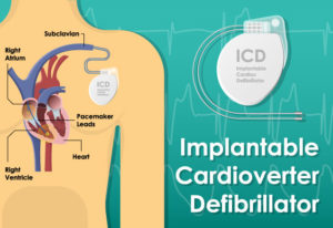 Implantable Cardioverter Defibrillator (ICD) Placement Diagram