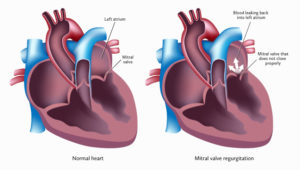 Mitral Valve Regurgitation Diagram