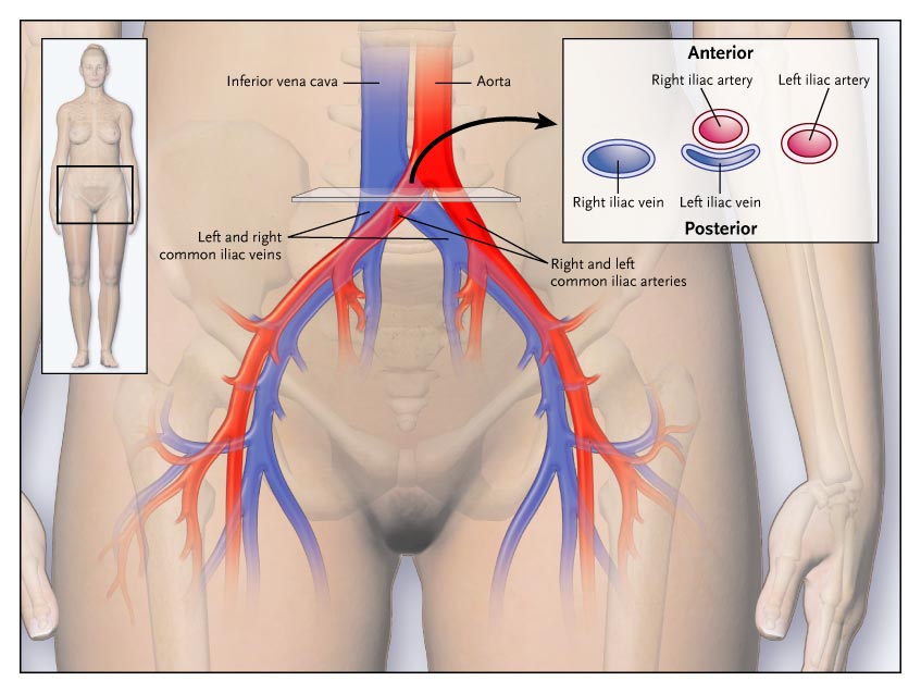 May-Thurner Syndrome Diagram