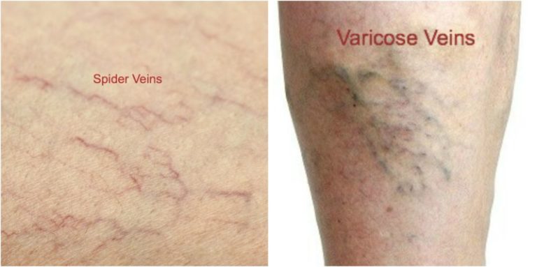 Do I Have Varicose Veins Cardiovascular Institute Of The Shoals