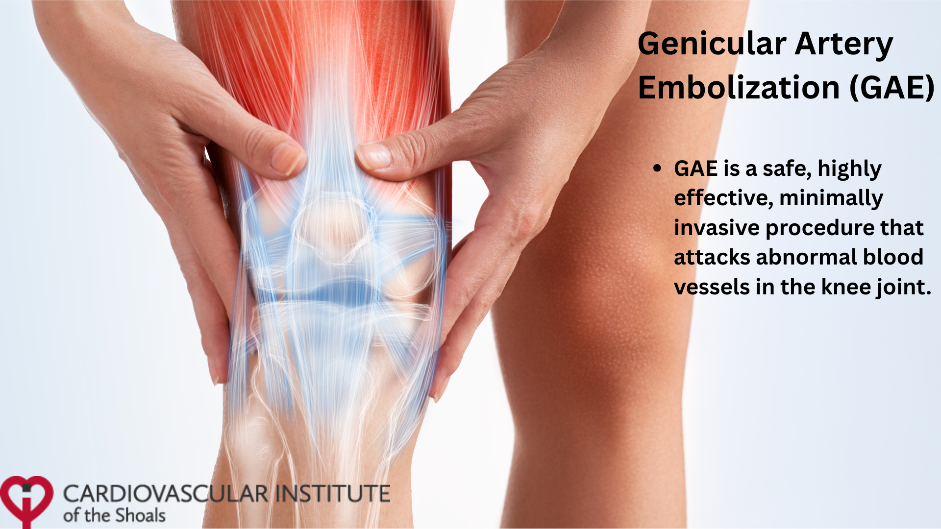 GAE Procedure for knee pain.